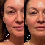 XERF TREATMENT